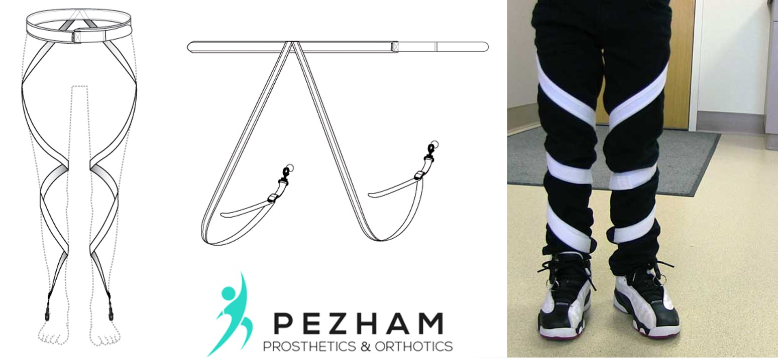 راه رفتن با پنجه رو به داخل.بریس تویستر