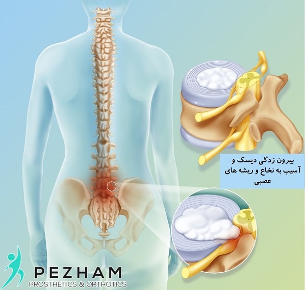 دیسک کمر.کمربند طبی دیسک کمر.کمربند طبی