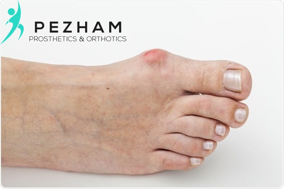 هالوکس والگوس.انحراف شست پا.قوز شست پا