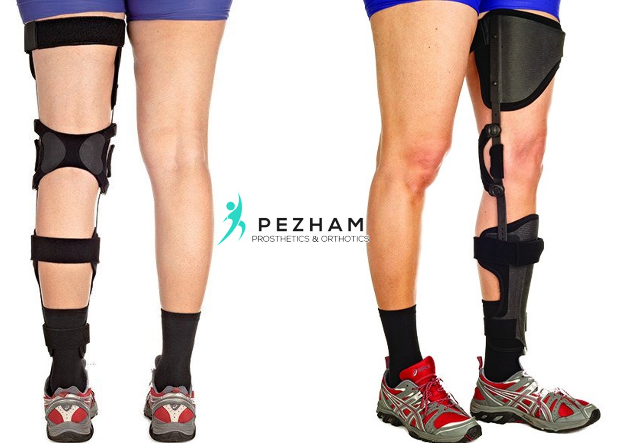 بدشکلی عقب زدگی زانو