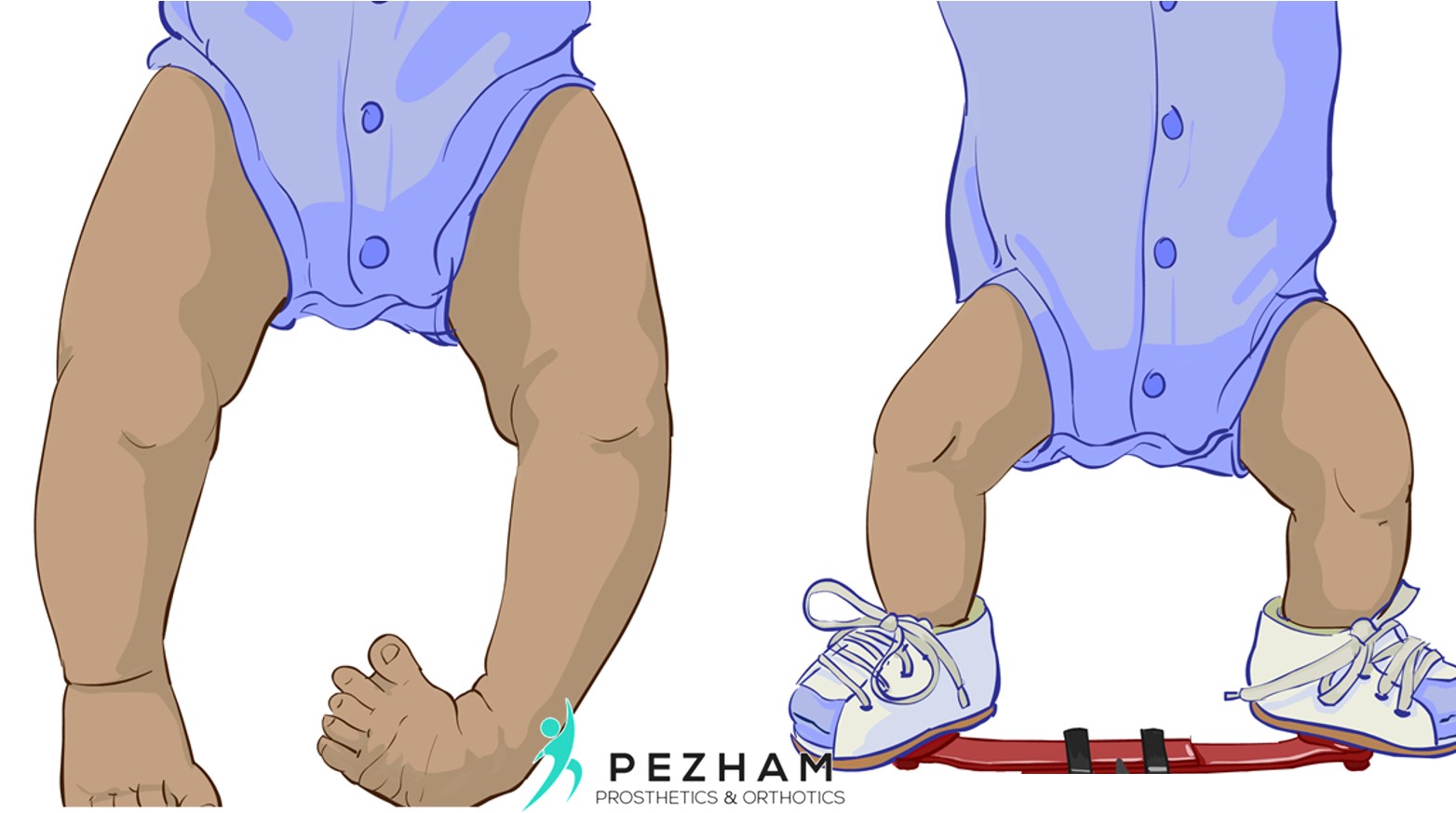 علت بازگشت کلاب فوت.علت کلاب فوت در جنین