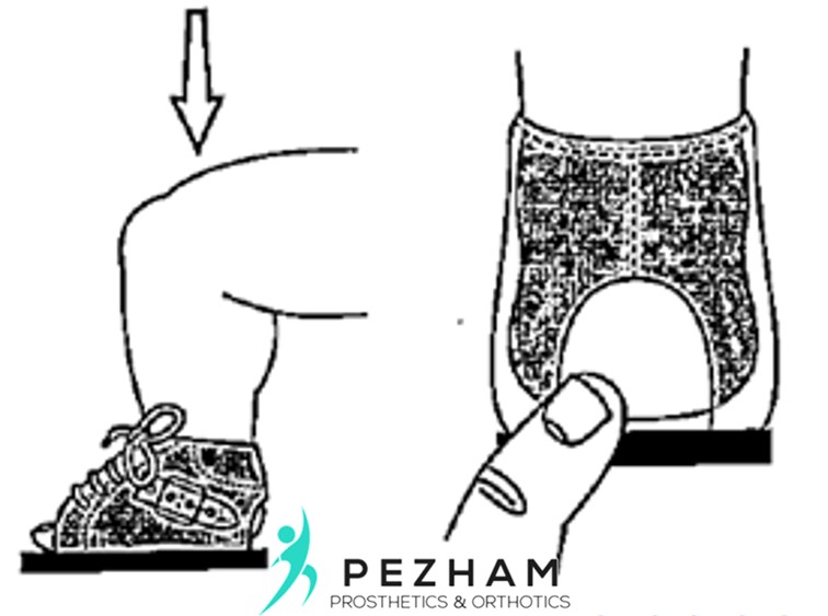 پوشیدن بریس کلاب فوت