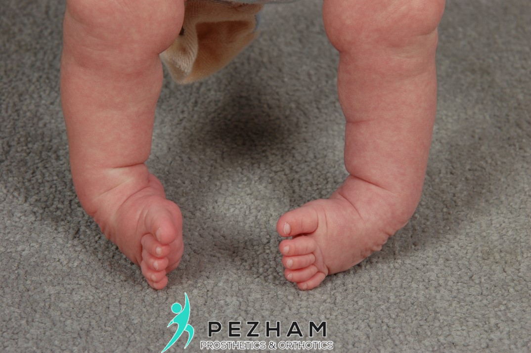 کلاب فوت درمان شده. کفش مخصوص کلاب فوت