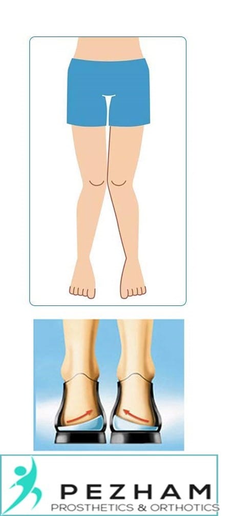 درمان غیر جراحی پای ضربدری