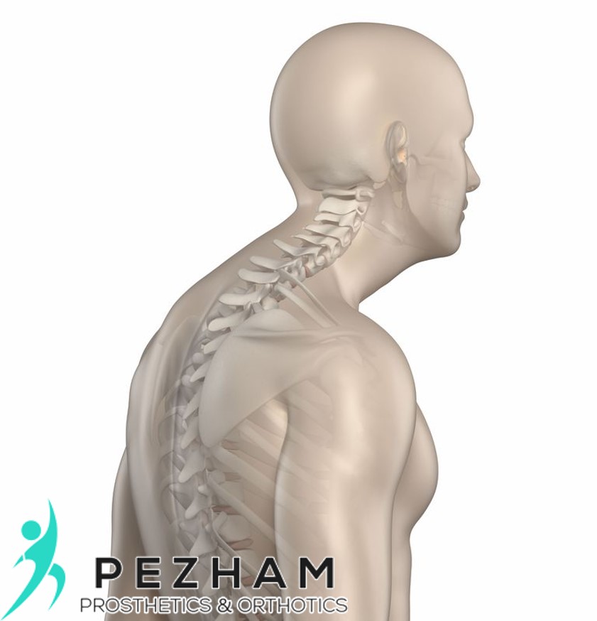 قوزپشتی.بریس.درمان