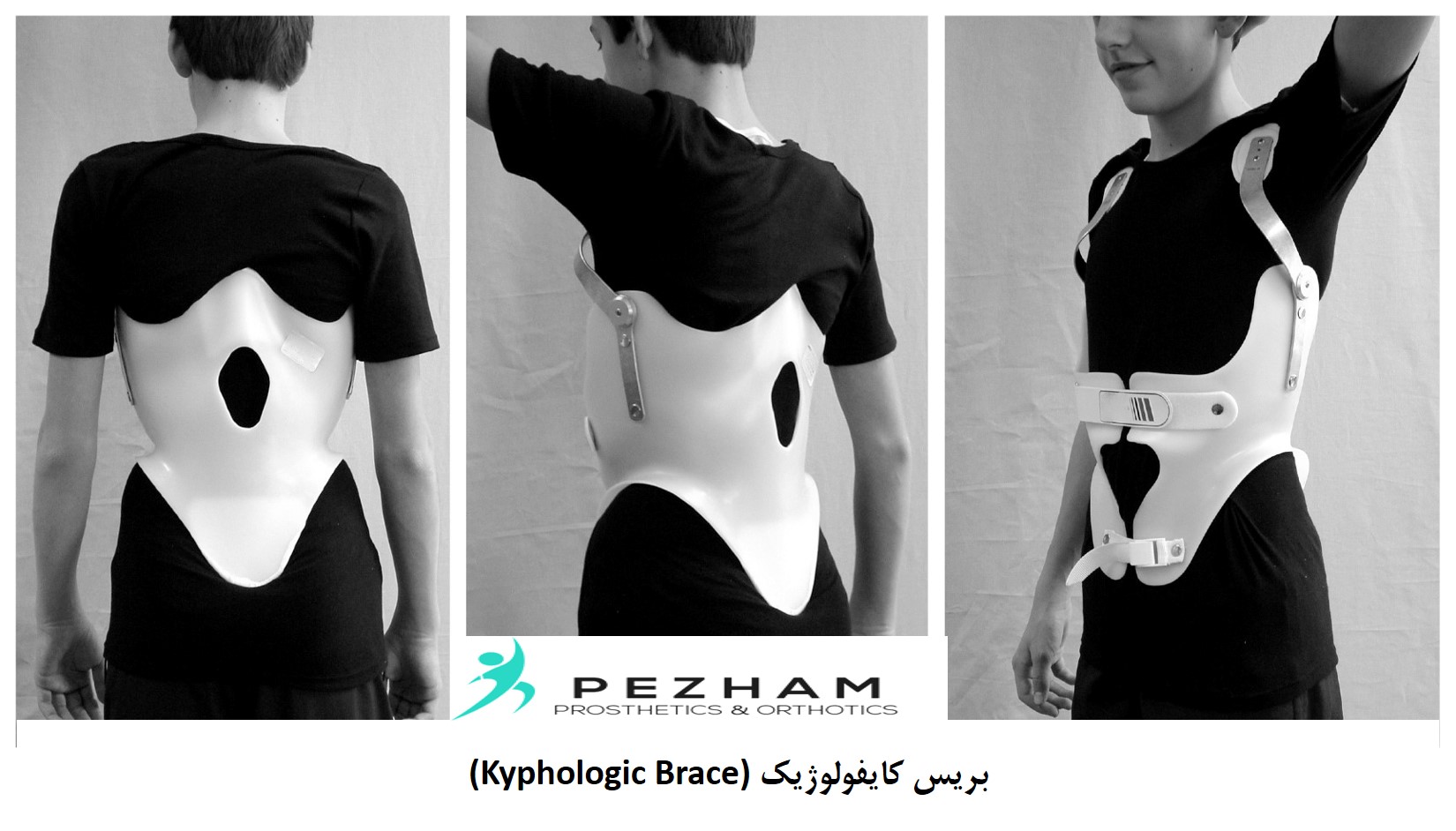 بریس.قوز پشتی.کایفولوژیک