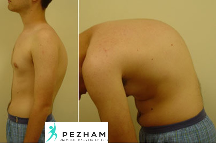 قوز پشتی برگشت ناپذیر.کایفوز شوئرمن.بریس.درمان