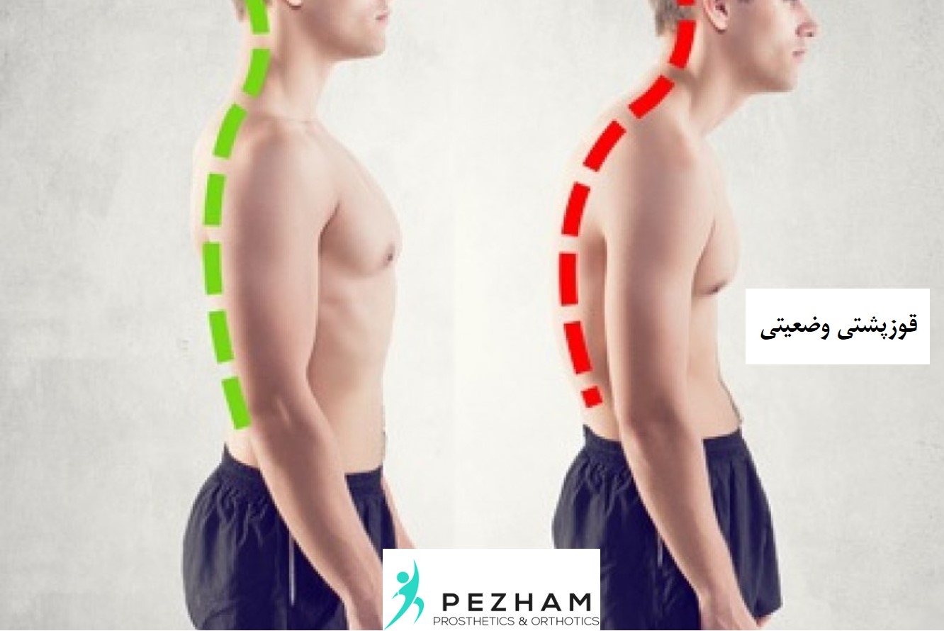 قوز پشتی وضعیتی.قوز پشتی برگشت پذیر.بریس.درمان
