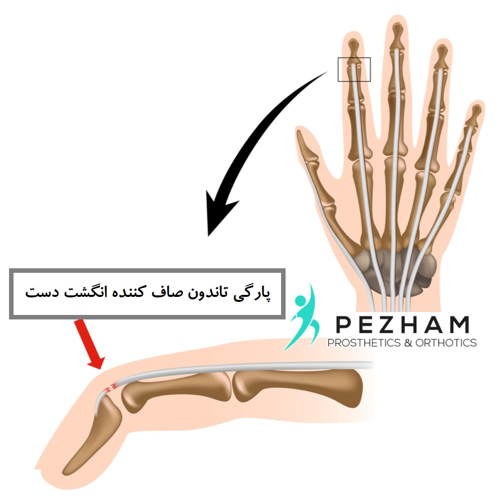 انگشت چکشی دست