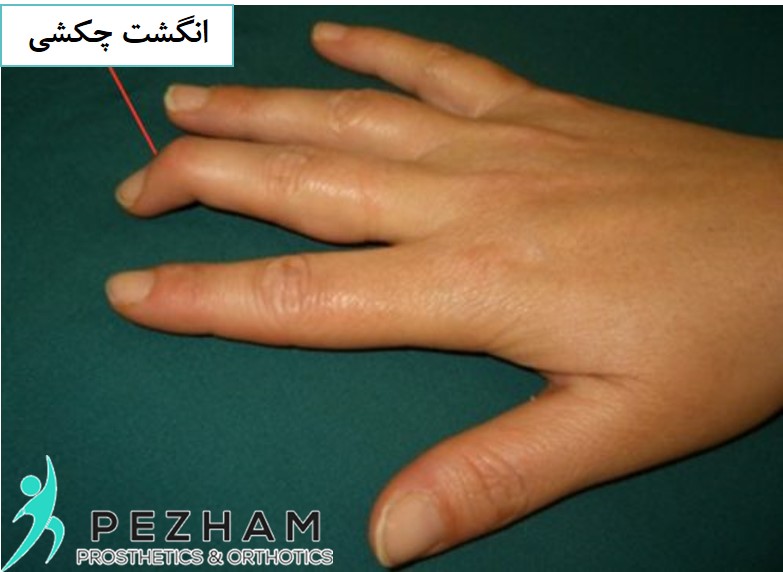انگشت چکشی دست