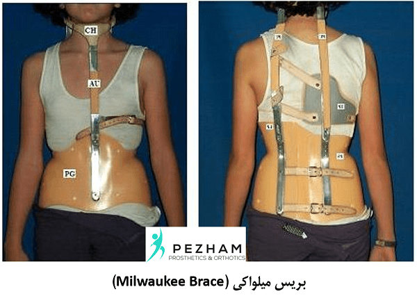 بریس میلواکی.بریس اسکولیوز.درمان اسکولیوز.اسکولیوز